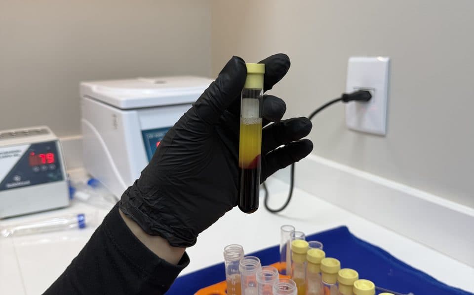 Tubo de Plasma Rico em Plaquetas após centrifugação, preparado na clínica